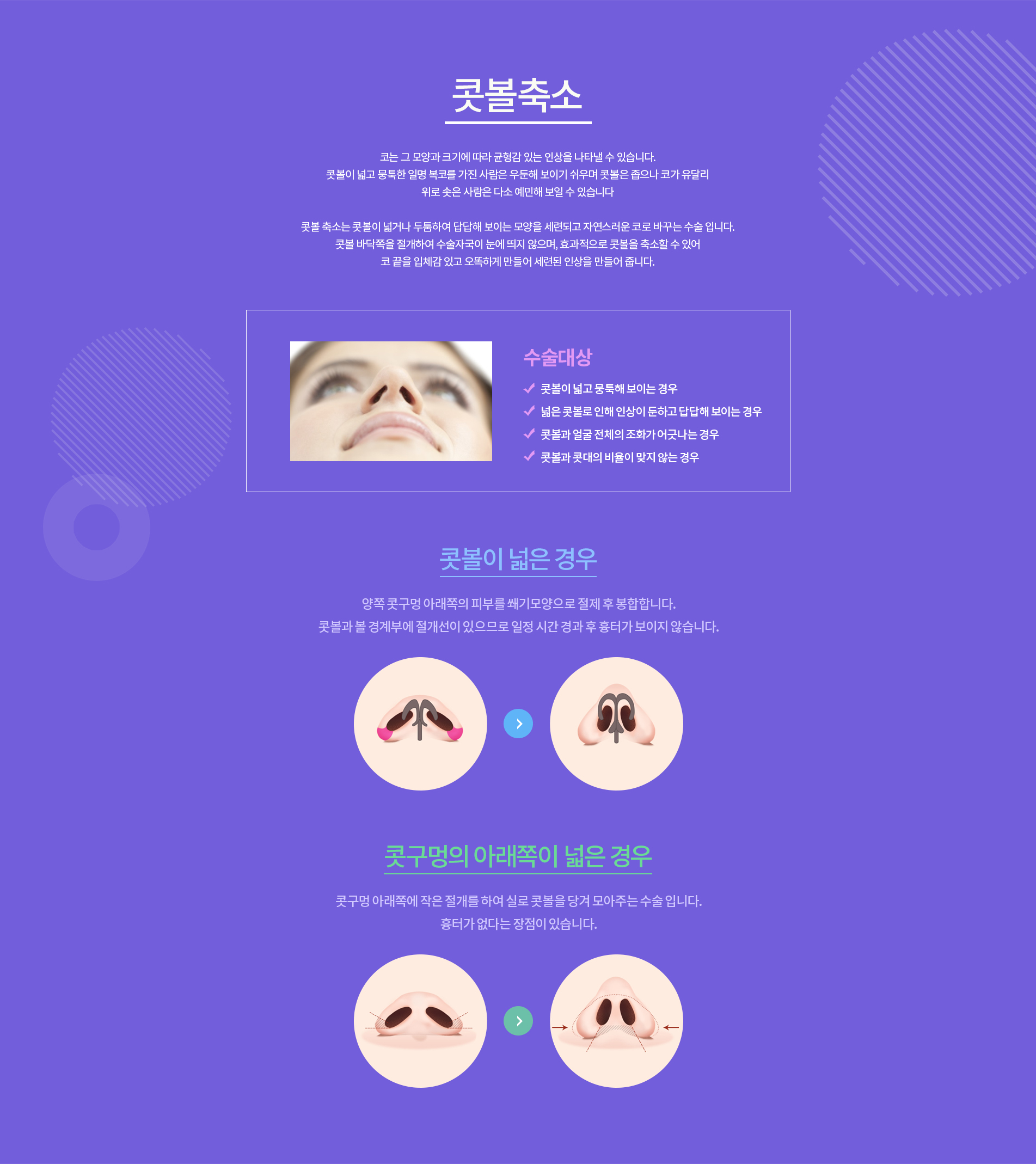 콧볼축소