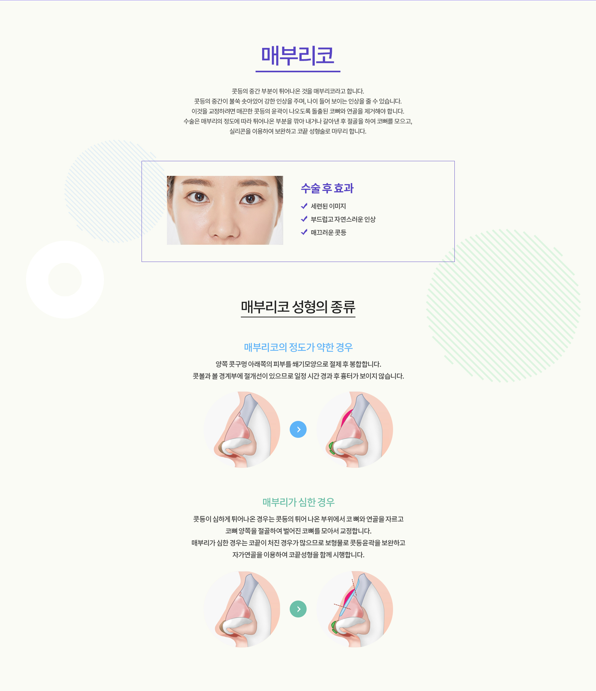 매부리코